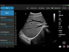 電子凸の配列の携帯電話のための無線超音波装置
