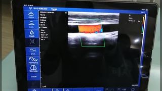 128 素子デュアルヘッドワイヤレス超音波プローブ