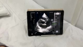 心臓およびPOCUS用デュアルヘッドワイヤレス超音波プローブ
