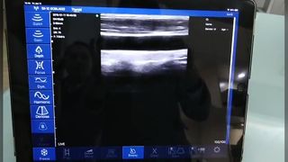 精密な誘導のためのワイヤレスリニア超音波スキャナー