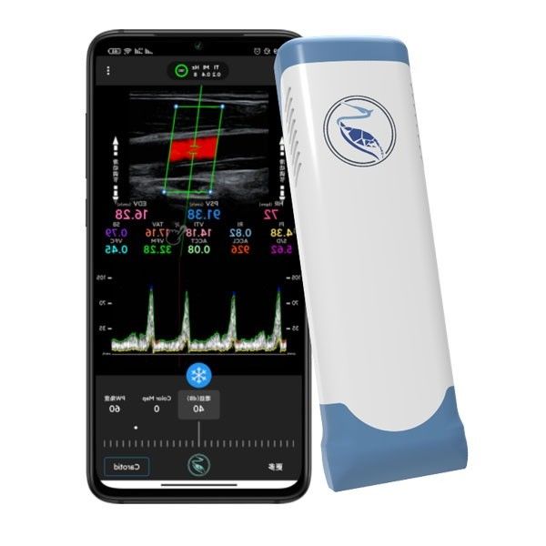 エコー色のドップラー無線手持ち型の超音波の走査器100フレーム